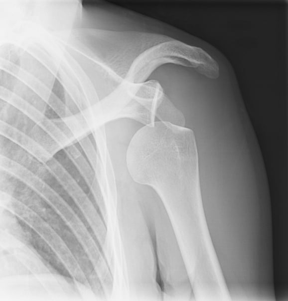 How to Tell If You Have A Dislocated Shoulder
